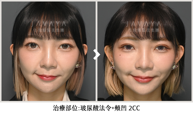 柔和順眼的自然蛻變：女神玻尿酸OBT 2CC帶來的視覺驚豔-Before&After（正面）｜案例見證-安夏Mika